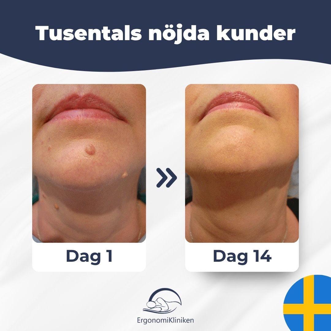 Hudfliksborttagare