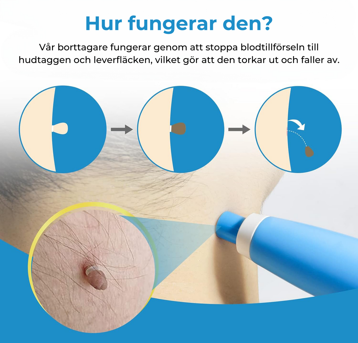 Leverfläcksborttagning - borttagning av födelsemärke