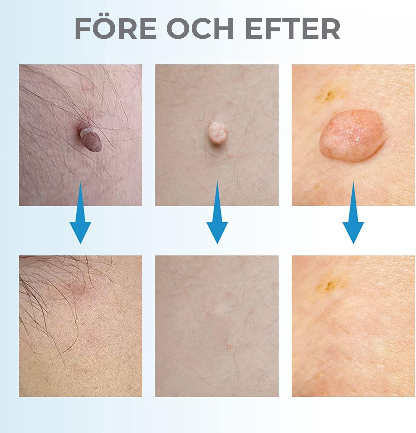 Leverfläcksborttagning - borttagning av födelsemärke