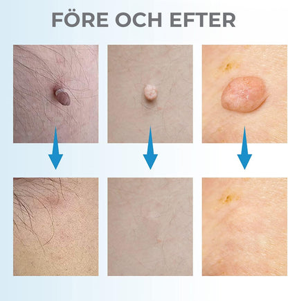 Leverfläcksborttagning - borttagning av födelsemärke
